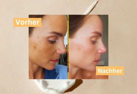 Tretinoin Vorher Nachher-ALT_SMALL_IMG